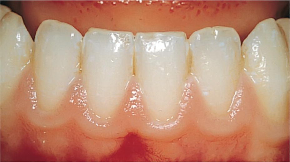 Photo of mandibular teeth with clinically healthy permanent tooth gingiva.