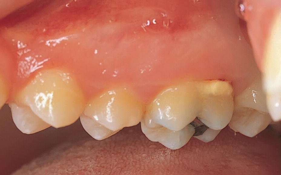 Photo of maxillary teeth with supragingival calculus.