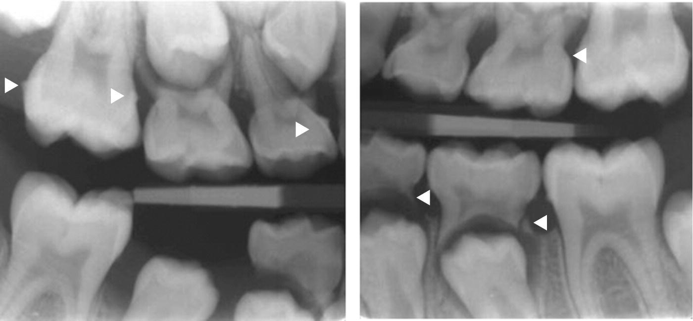 Bitewing radiographs presenting proximal calculus on primary and permanent teeth. Arrow heads indicate subgingival calculus.