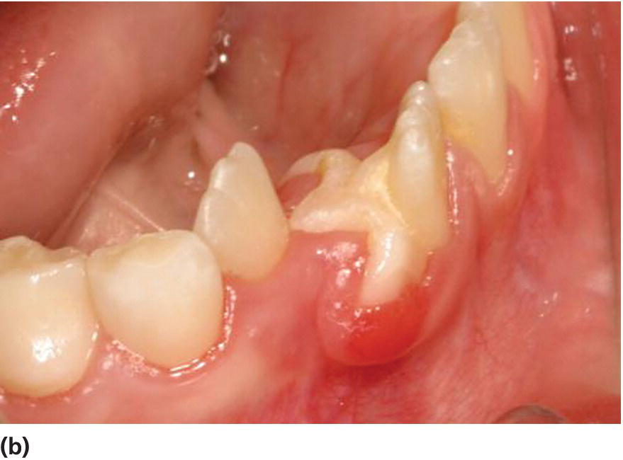 Photo of distofacial view of tooth 41 displaying  gingivitis in relation to dens geminatus in the incisal region of the lower jaw.