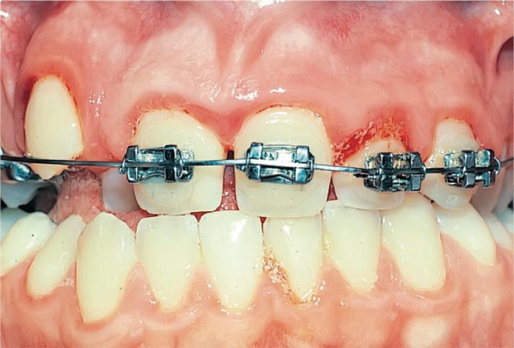 Photo displaying poor oral hygiene and gingivitis in a patient undergoing orthodontic treatment.