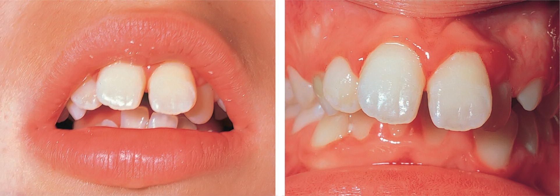 2 Photos of a patient’s mouth (left) and bite (right) displaying chronic gingivitis associated with mouth breathing.