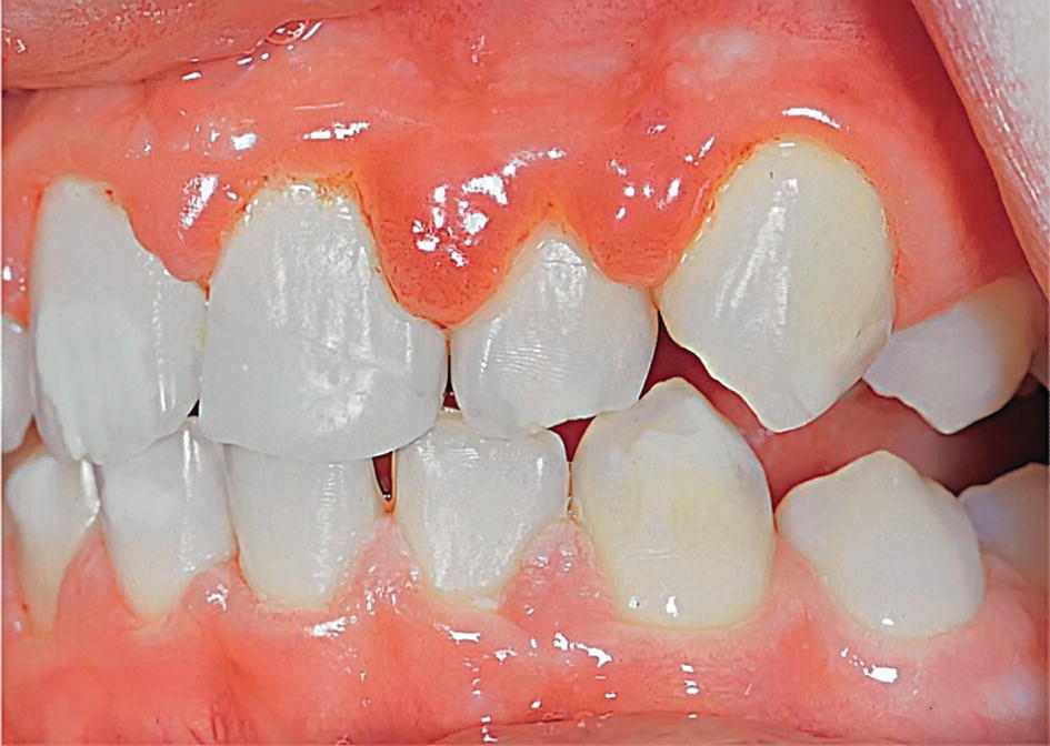 Photo displaying a patient’s bite displaying edematous gingival inflammatory reaction during puberty.