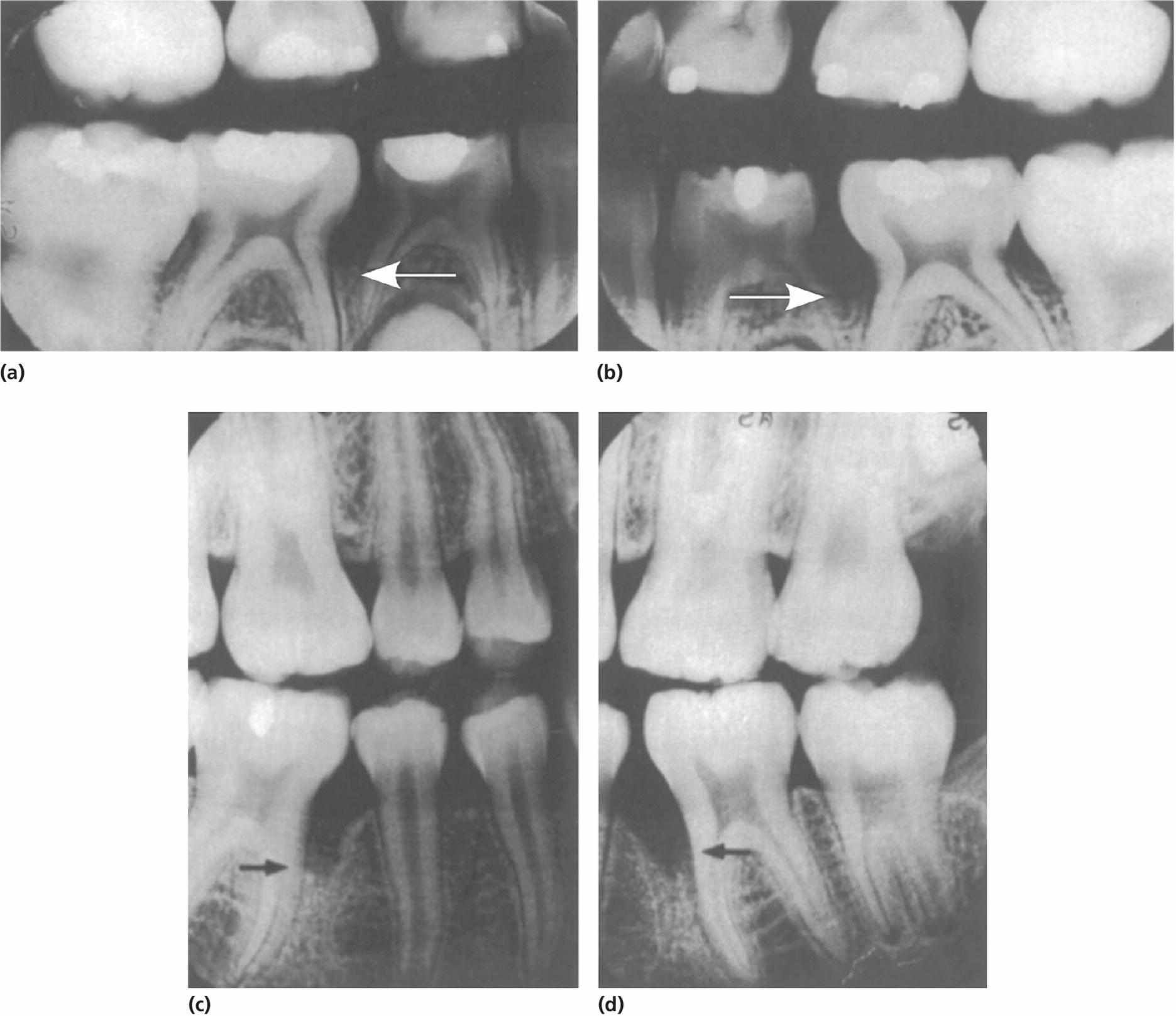 Dental radiographs of a 14-year-old boy presenting loss of bone support with arrows pointing the location (a, b) that developed into localized aggressive periodontitis (c,d).