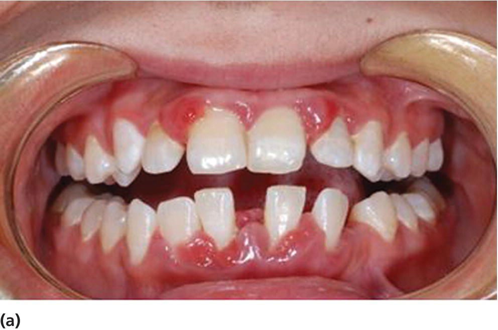 Photo of the teeth of a 19-year-old patient with diabetes mellitus and poor metabolic control, displaying aggressive periodontitis.