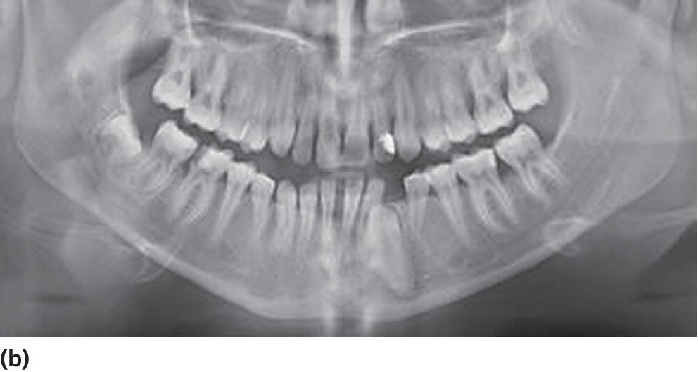 Panoramic radiograph displaying aggressive periodontitis in a 19-year-old patient with diabetes mellitus with poor metabolic control.