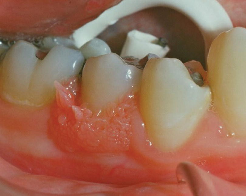 Photo displaying a wart on the gums.