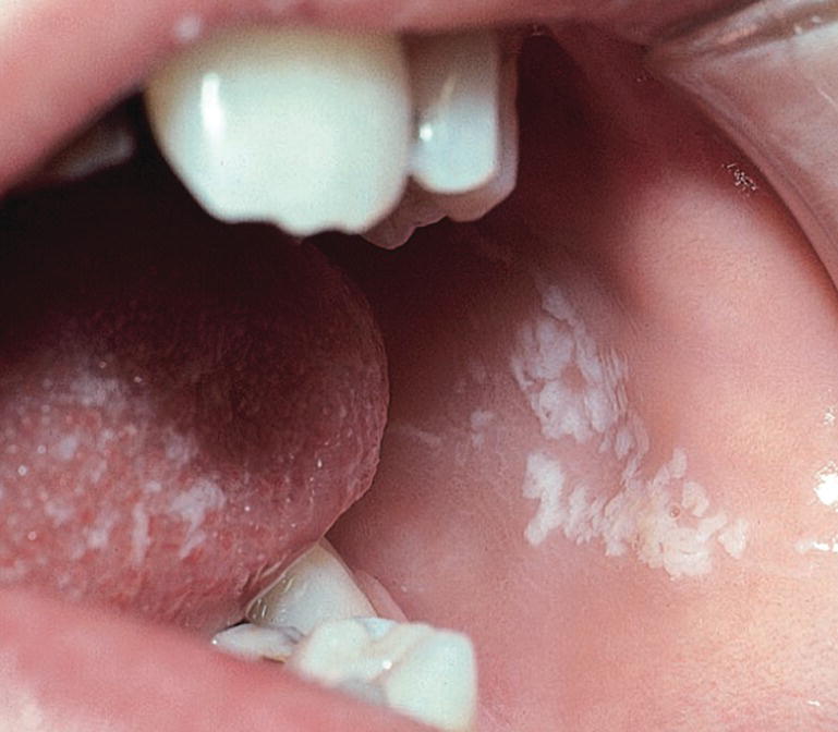 Photo displaying candidiasis lesion in cheek mucosa.