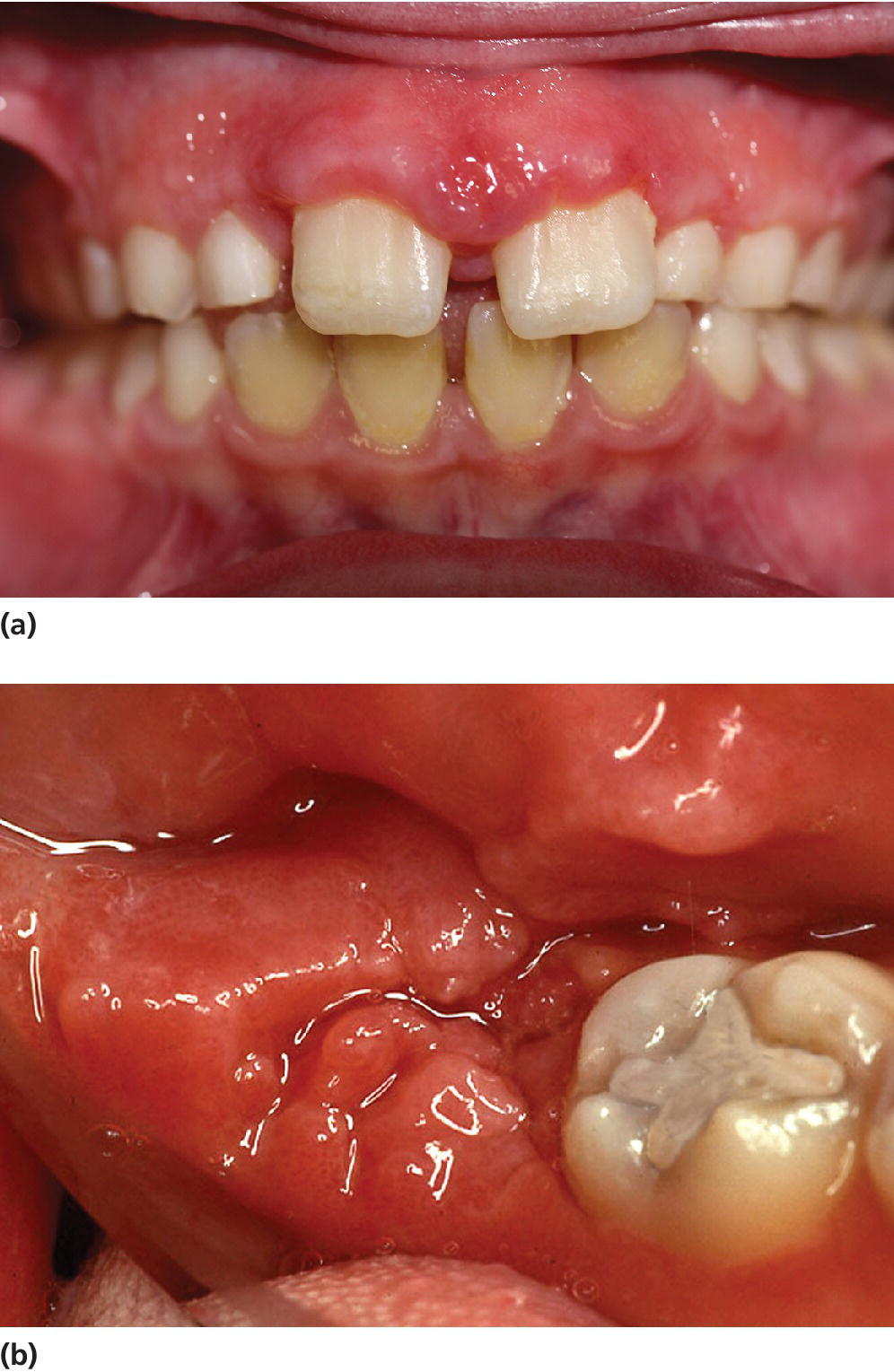 Photo of Crohn’s disease displaying gingival characteristics on the incisal region (top) and molar region (bottom).