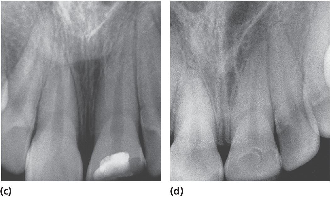 2 Radiographs partial pulpotomy of a permanent incisor with complicated crown fracture at the time of treatment (c) and several years later (d).