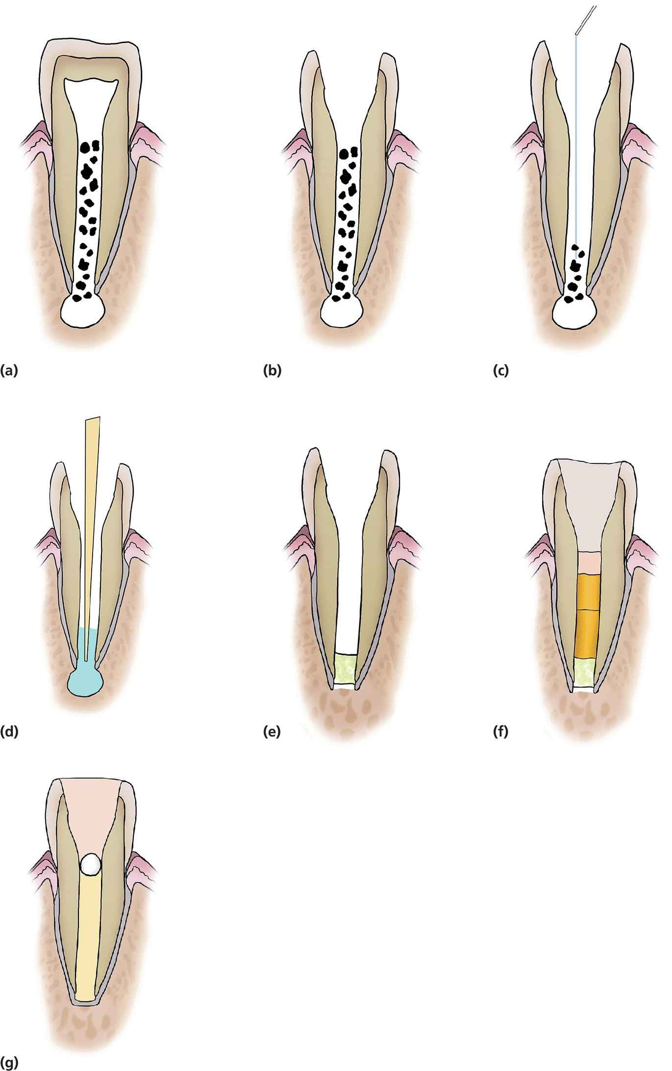 Diagrammatic representation of MTA plug and thermal guttapercha obturation of immature teeth.