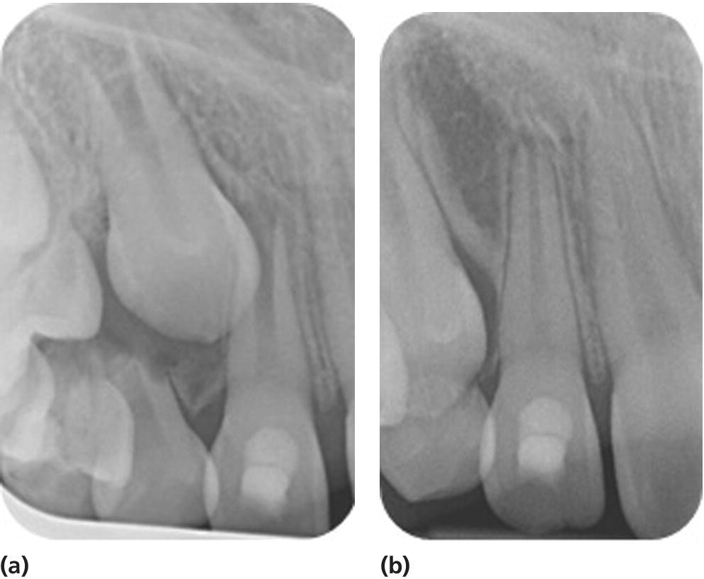 Radiographs displaying the continuation of root development in a patient treated with RET using blood clot as a scaffold on October 23, 2013 (left) and October 23, 2014 (right).