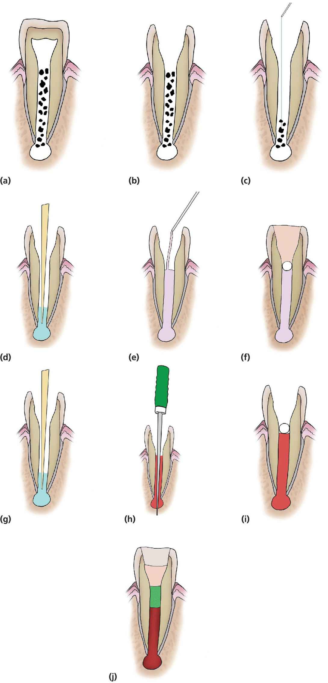 Diagrammatic representations of the stages of RET of immature teeth.