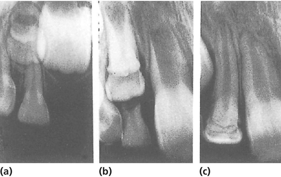 3 Radiographs of severe malformation of permanent lateral incisor after intrusive luxation of predecessor at 2 yrs. old with condition 1 yr. after trauma (a), deformed incisor (b) and uncomplicated eruption(c).