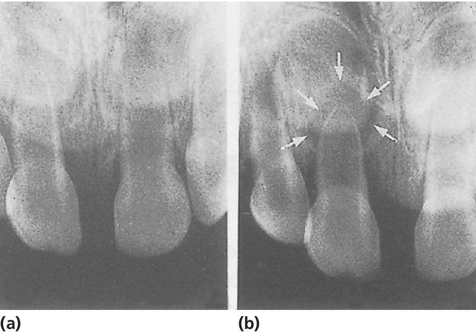 Radiographs taken 1 week after slight intrusive luxation of right central incisor (left) and 3 months after the trauma with arrows pointing the periapical inflammation (right).