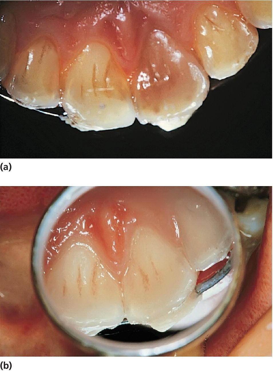 2 Photos displaying left central incisor in 10‐year‐old boy discolored within 1 week after subluxation injury (top) and disappearing discoloration 3 months later (bottom).