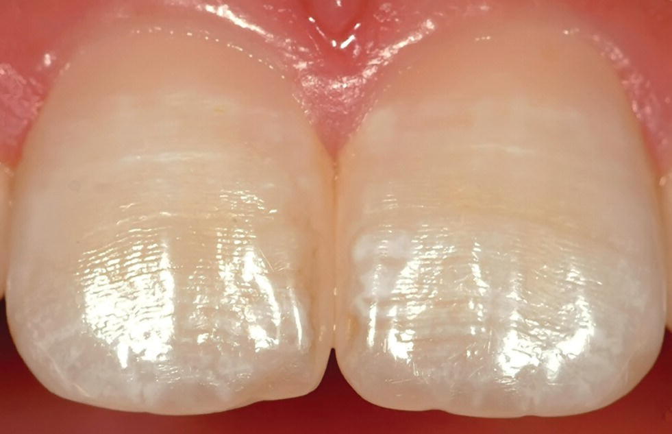 Photo displaying perikymata as horizontal lines on buccal surfaces of central incisors and white, opaque patches and lines representing enamel disturbances.