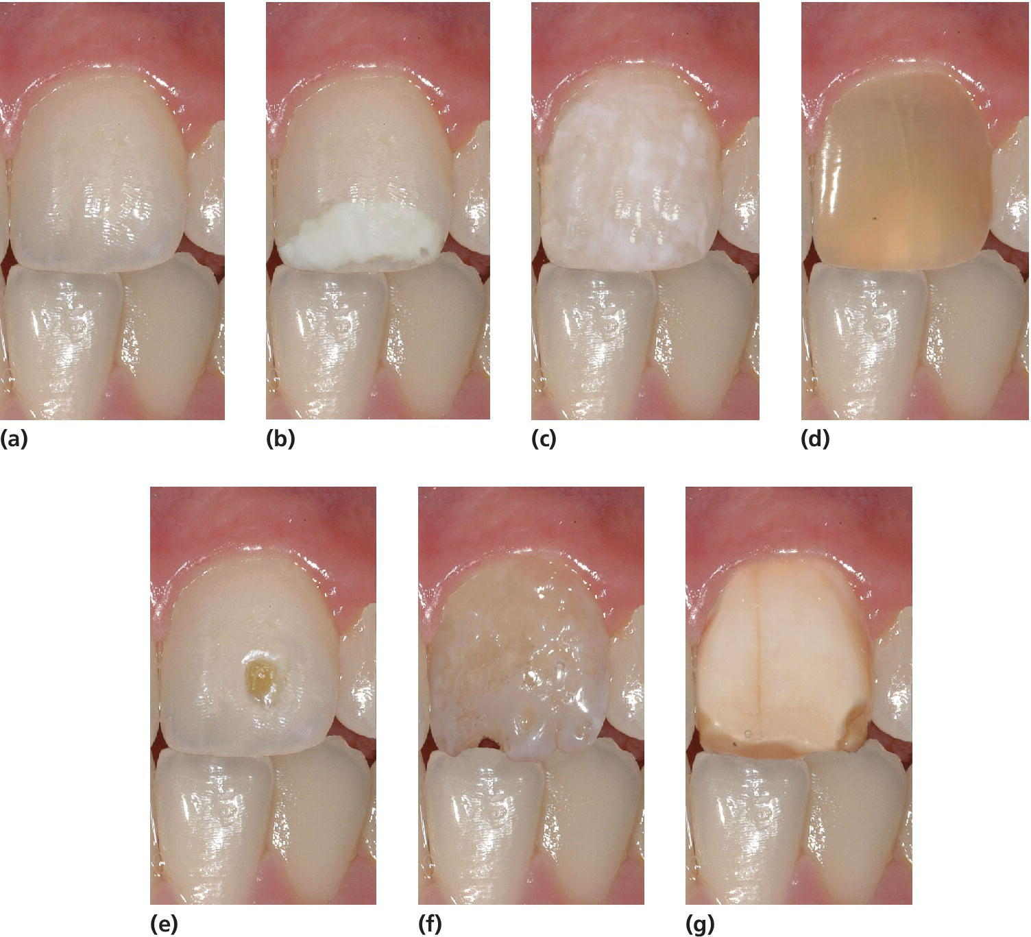 7 Photos of incisor 21, displaying the tooth in its natural appearance and illustrating classification and examples of 6 types of enamel defects due to disturbances in the tooth formation.