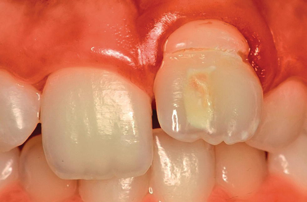 Photo of a 30-month-old maxillary left central incisor with hypoplasia and opacity due to intrusion trauma of primary incisor.