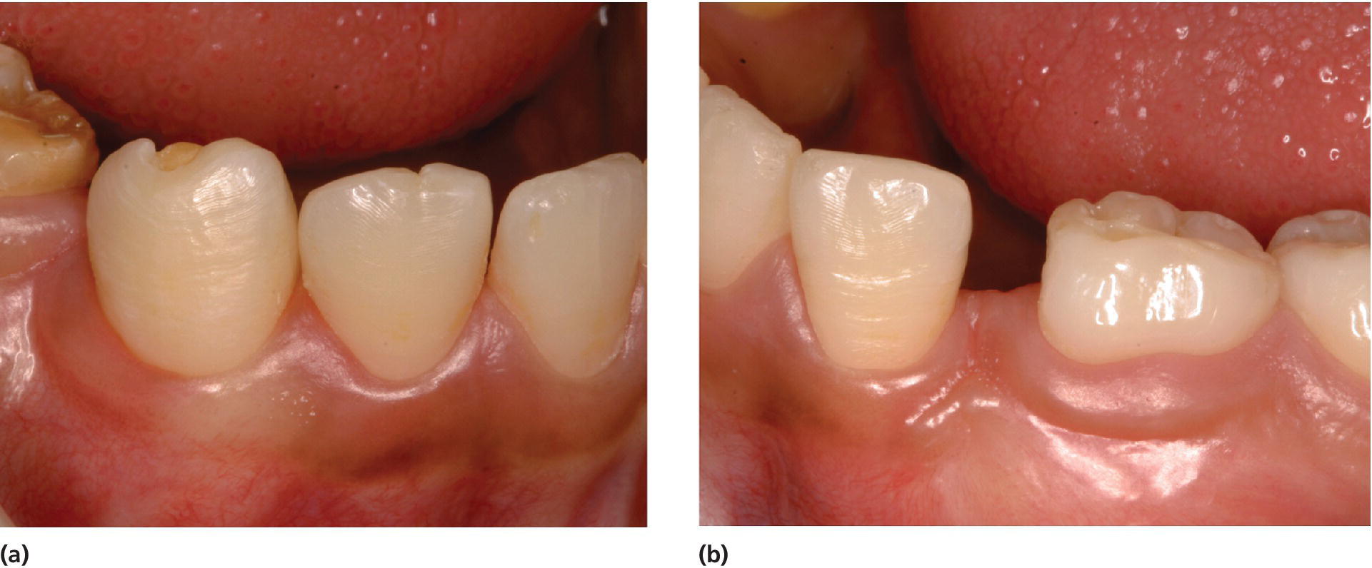 2 Photos displaying hypoplasia with exposure of dentin of the right lower permanent canine (left) and absence of the left lower permanent canine due to removal of the tooth germ (right).