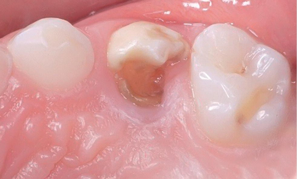 Photo of teeth of a 6-year-old girl with an erupting deffective 24.