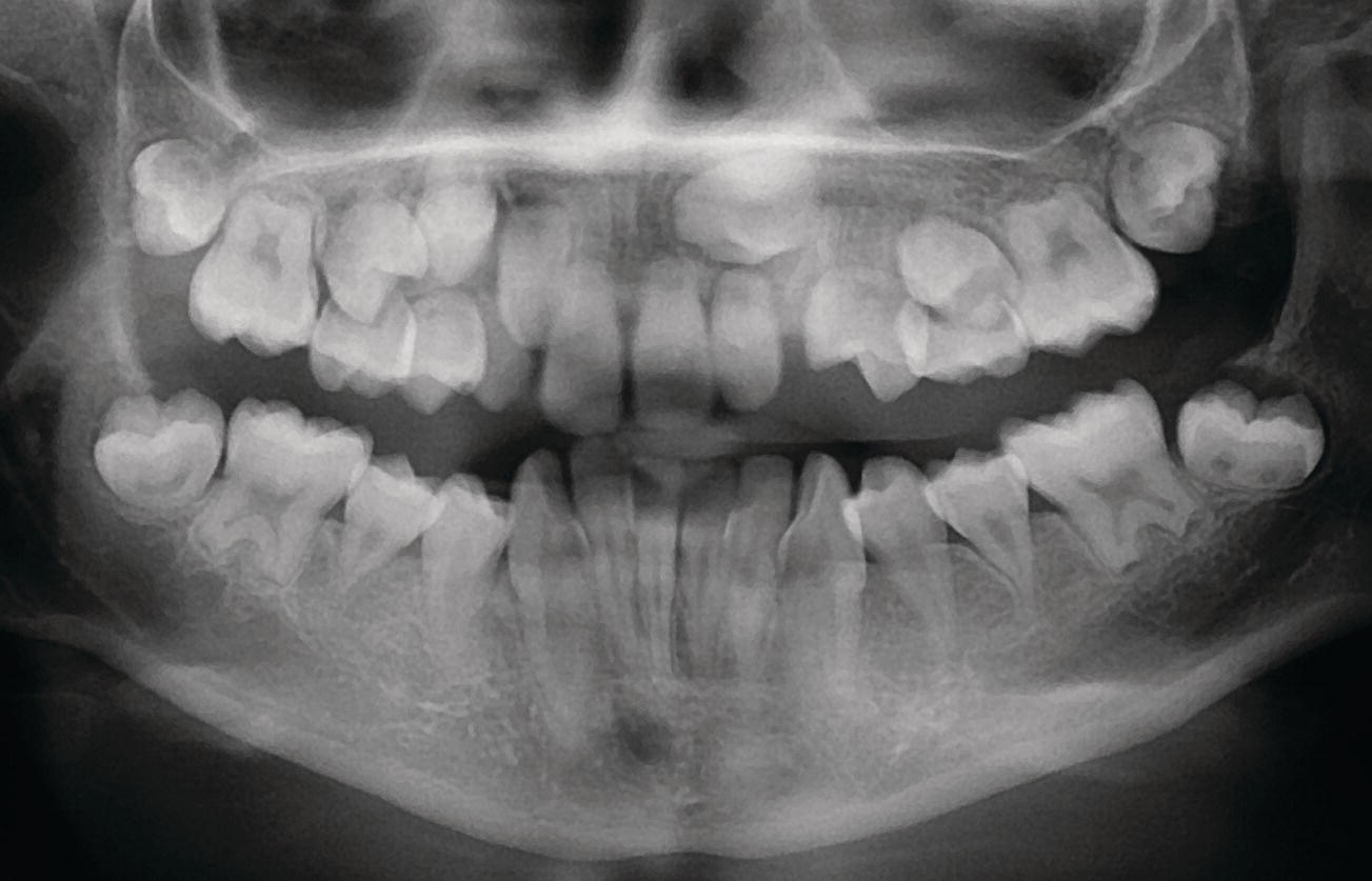 Panoramic radiograph displaying the arrested root development of a 13-year-old girl.