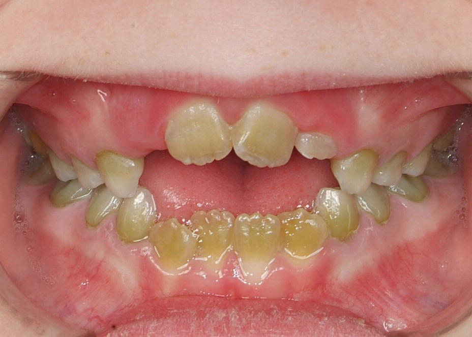 Photo of teeth of a 7-year-old child with pigmentation in both primary and permanent teeth.