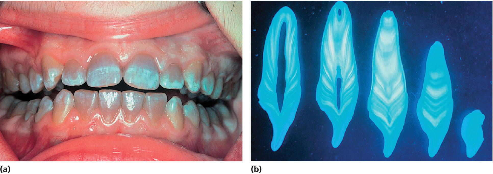 2 Photos of teeth of a 14-year-old girl exhibiting tetracycline stains (left) and a screen capture of histologic sections of tooth illustrating bands of tetracycline staining (right).