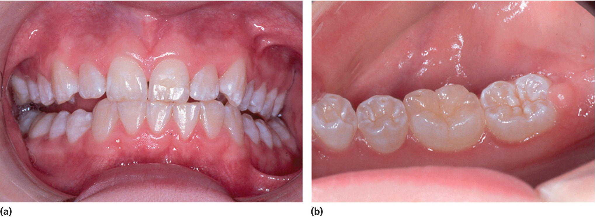 2 Photos of teeth and gums (left) and of the left molars and 2nd cuspid of a 15-year-old girl demonstrating mild fluorosis (right).