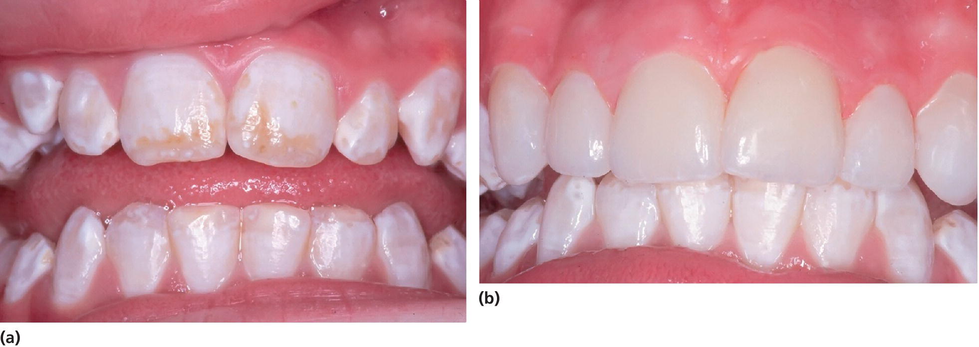 Photos of teeth and gums of 13-year-old girl, displaying moderate dental fluorosis (left) and porcelain veneers attached to the upper left canine to the upper right (right).