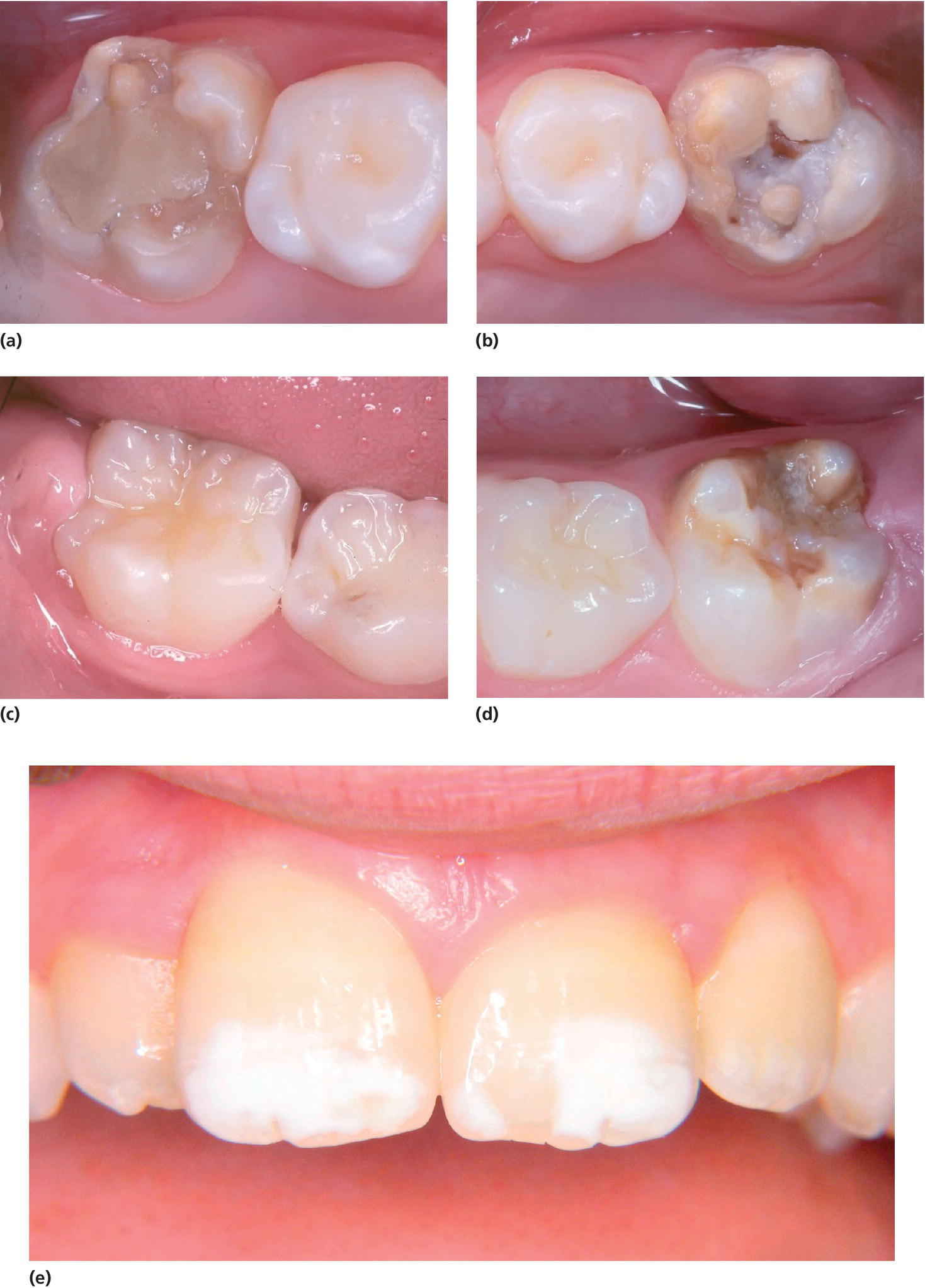 Photos of molar–incisor hypomineralization in 8‐year‐old. They display 16 with a defective restoration, 26 with disintegrated enamel and caries, 46 healthy, 36 disintegrated enamel, and demarcated opacitie.