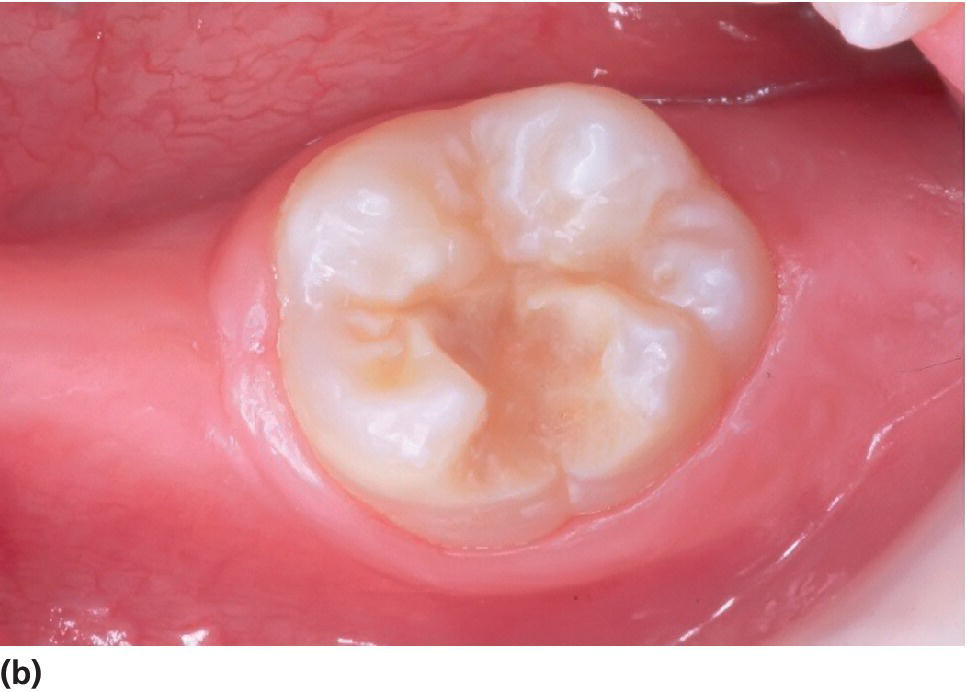 Photo displaying an erupting severely hypomineralized lower first molar 6 months later with heavy disintegration.
