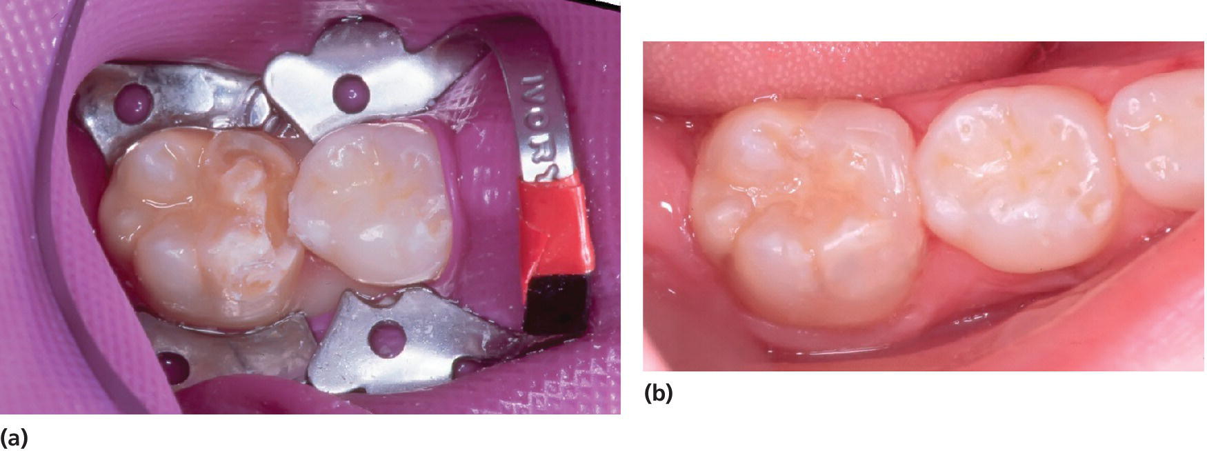 2 Photos displaying 2 molars of an 8-year-old girl affected with MIH with dental surrounding it ready for restoration (left) and the same molars right after restoration with composite (right).