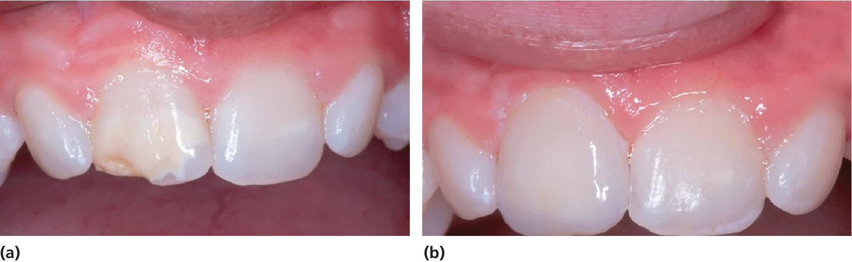 2 Photos displaying upper incisors and gums of a 13-year-old boy with MIH (left) and the same teeth with enamel disintegration on the upper left central incisor restored with porcelain veneer (right).