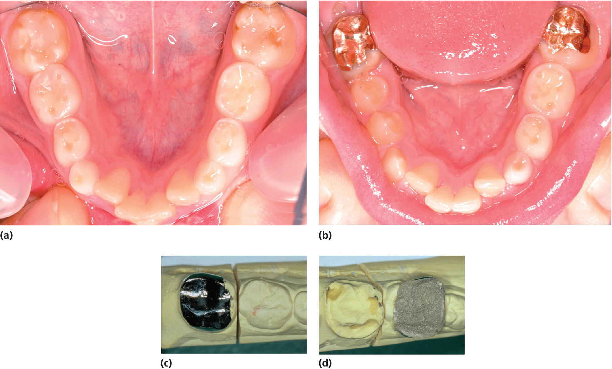 4 Photos displaying dentition with hypomineralized permanent first molars with opacities, posteruptive enamel breakdown along the margins of composite fillings and treatment with cast‐gold copings.
