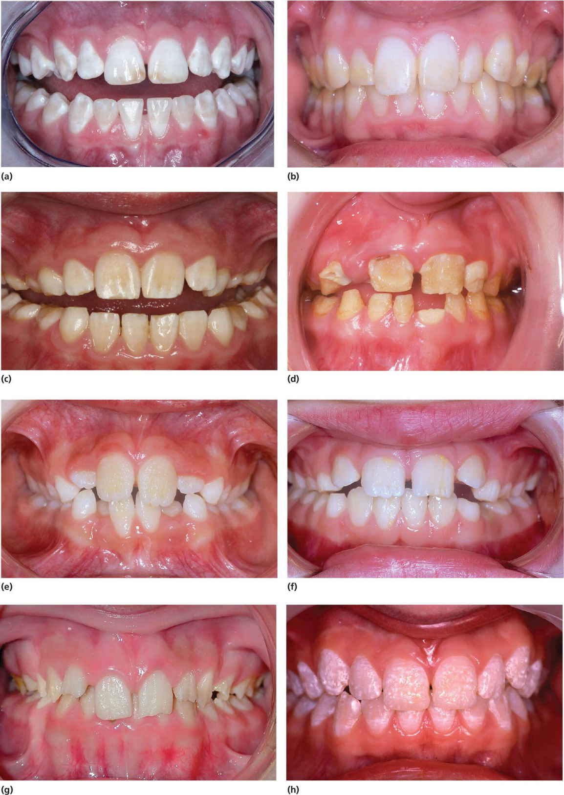 8 Photos displaying dentition with amelogenesis imperfecta, and varying types of hypomaturation, hypocalcification of enamel, hypoplasticity, and a combination of hypomaturation and hypoplastic type.