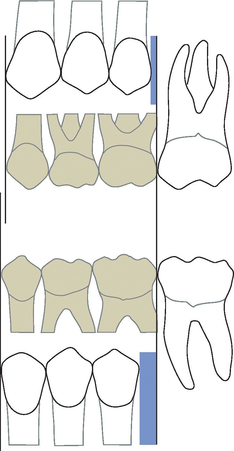 Illustration of primary canines and molars occupying more space. It displays “leeway space” which is greater in the mandible (2.5 mm) than in the maxilla (1.5 mm).