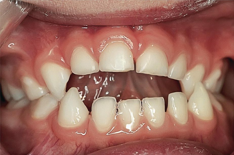 Photo of the posterior cross bite (patient’s left side). It displays the midline deviation and mandibular lateral shift, and frontal open bite in a dummy sucker.