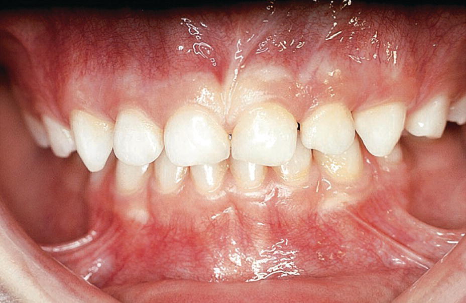 Photo of a human dentition with bilateral scissors bite in combination with forced distal occlusion.