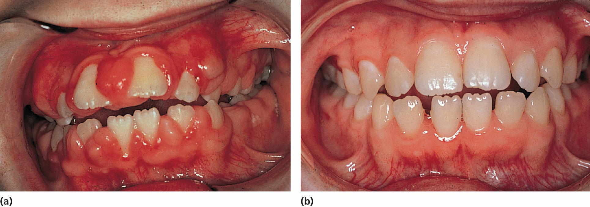 Left: Photo of a 10‐year‐old girl exhibiting severe gingival overgrowth. Right: Photo of a girl at 13 years, exhibiting a normal gingival 1 year after gingivectomy and discontinuation of phenytoin medication.