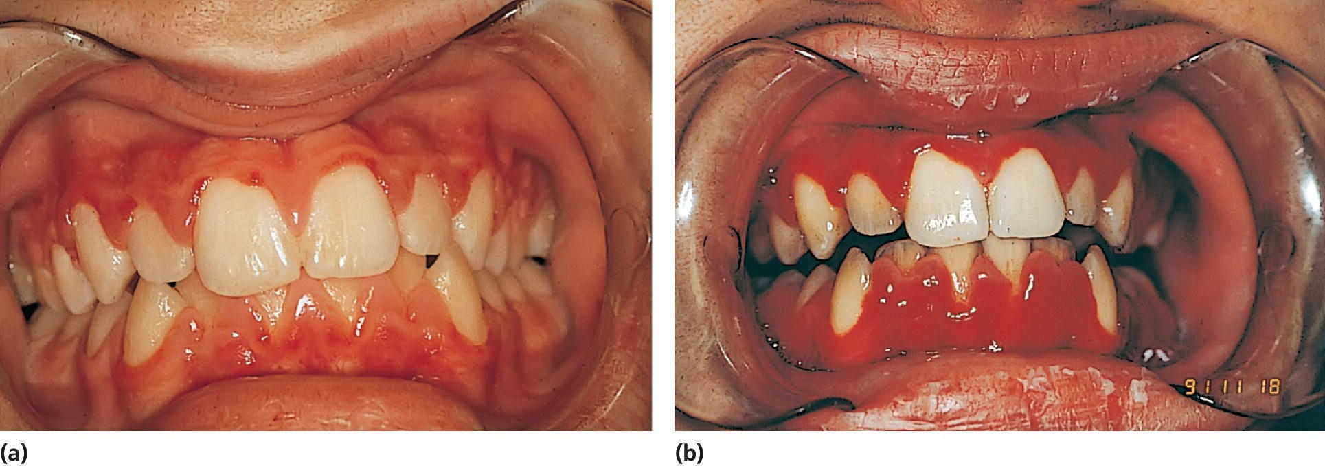 Left: Photo of a 15‐year‐old boy with aplastic anemia prescribed cyclosporine medication. Right: Photo of an 18-year-old boy with deteriorating gingival health coincidental with a hematological crisis.