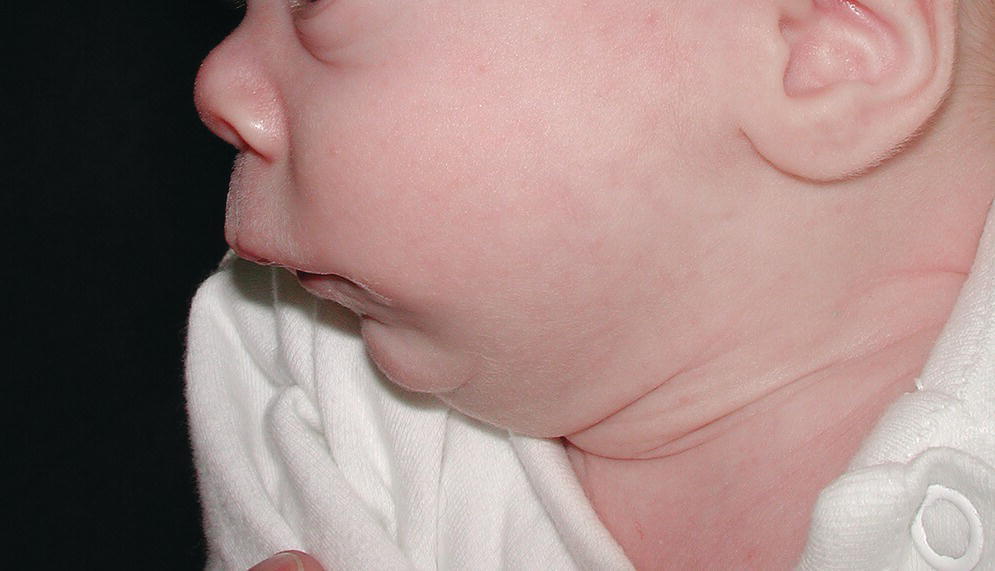 Photo of an infant with Robin sequence and cleft palate displaying marked hypoplasia of the mandible.