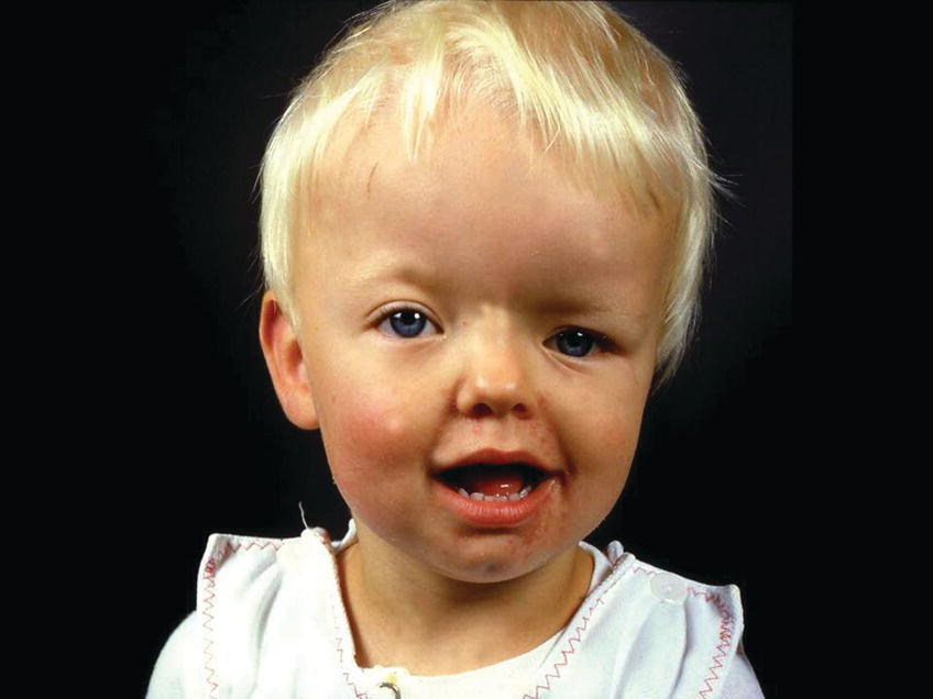 Photo of a 2‐year‐old girl with Münke syndrome and unicoronal synostosis. It displays a marked craniofacial asymmetry.