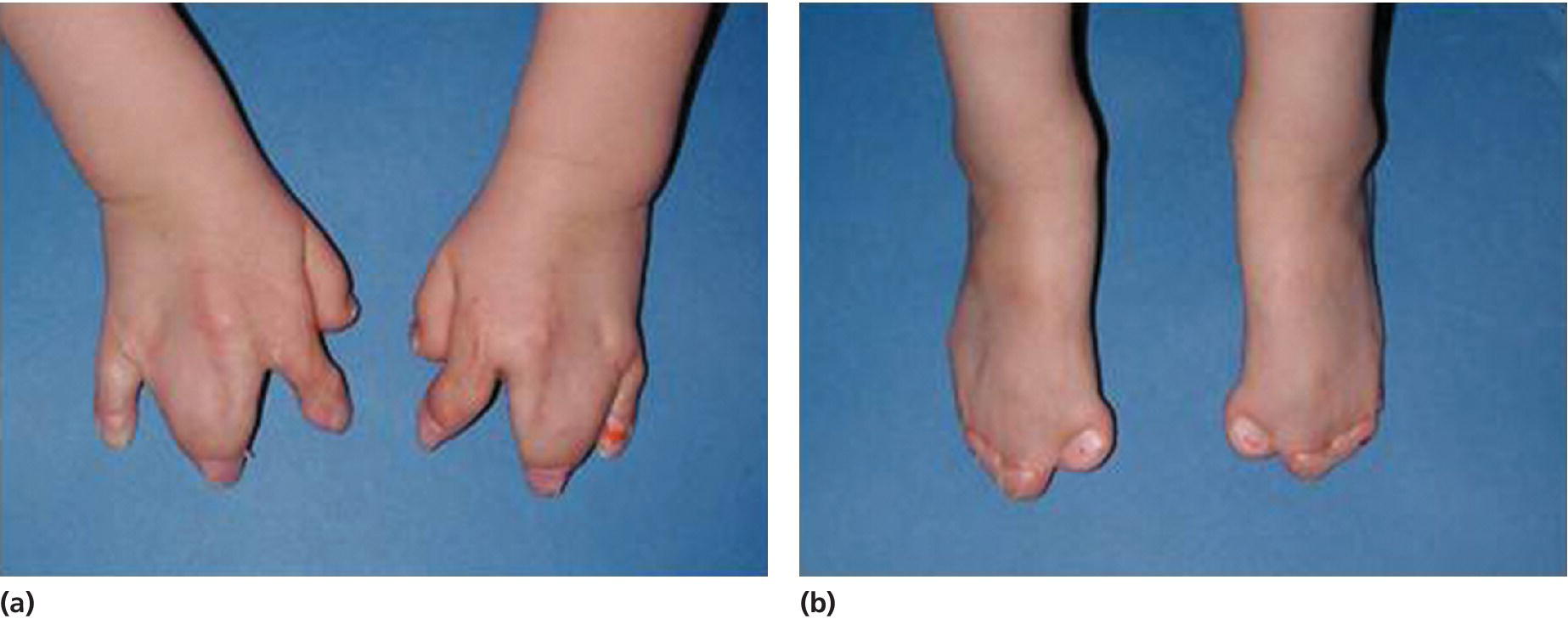Two photos displays symmetrical syndactyly of hands (left) and feet (right) in a 5-year-old girl with Apert syndrome.