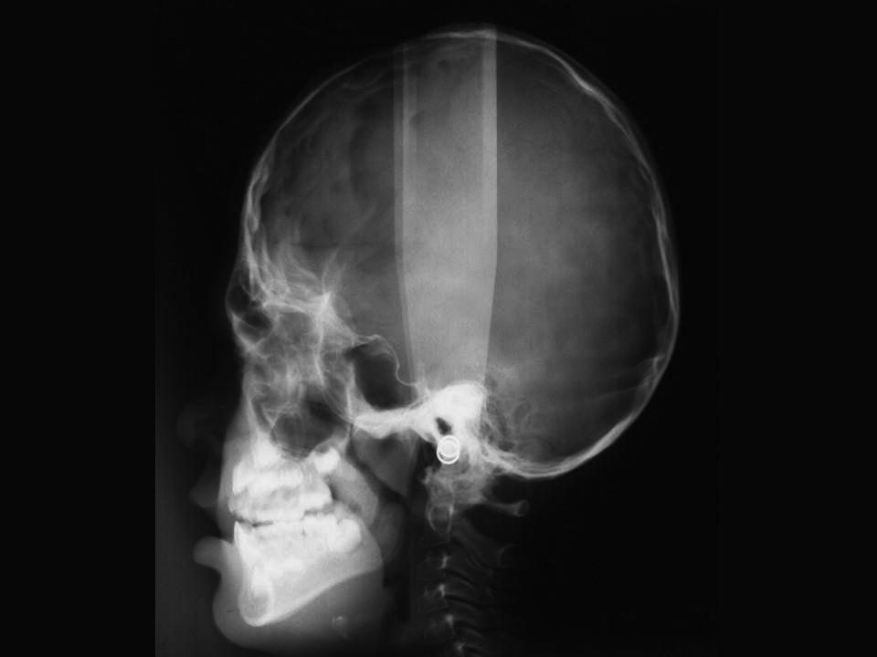 Skull X‐ray of a 5‐year‐old girl with Apert syndrome.
