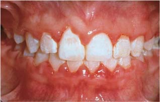 How do I correct a tooth decalcification?