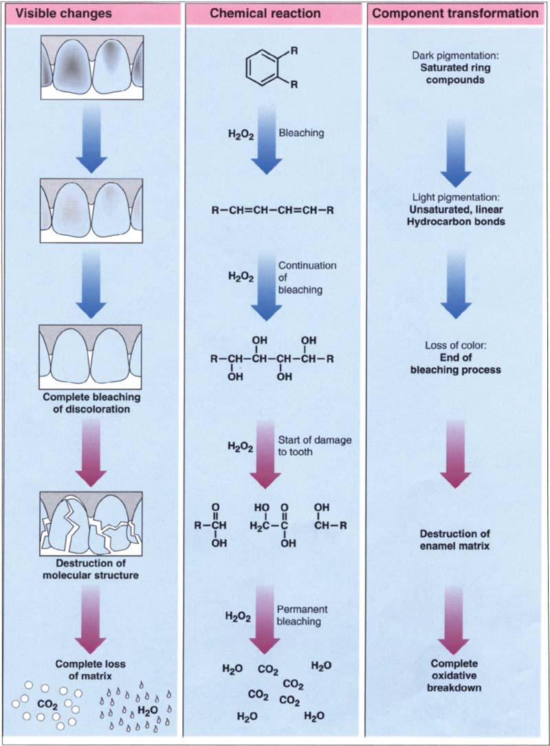 bleaching-pocket-dentistry