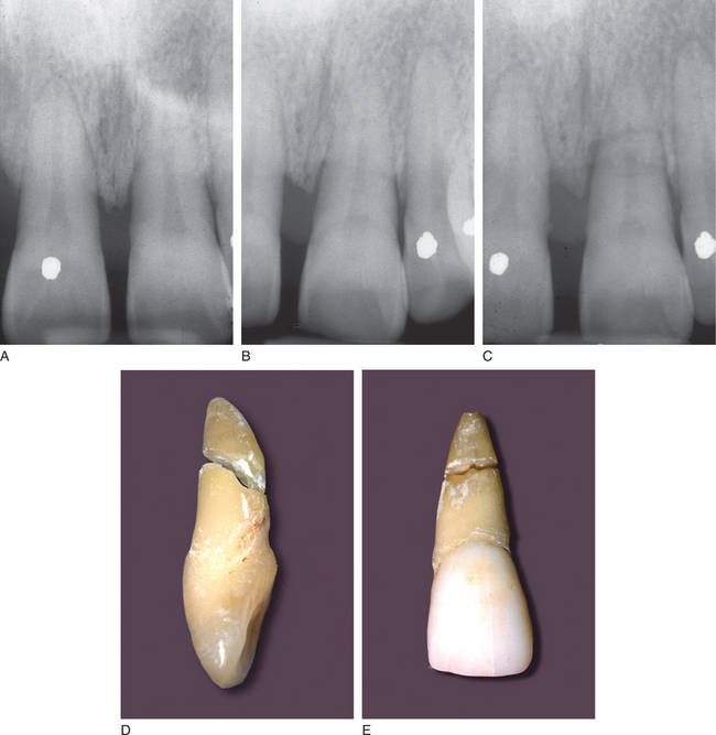 4 Intraalveolar Root Fractures Pocket Dentistry