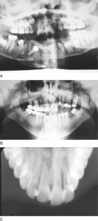 Alveolar Fractures Pocket Dentistry