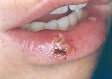 Infected Mouth Cut 89